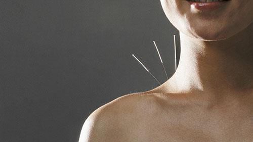 Akupunktur yapn<br>    Eski bir in tedavisi olan akupunktur, ince ineleri stratejik blgelere yerletirerek gerekletiriliyor. Pek ok insana korkutucu gelse de alerjisi olanlarn denemesinde fayda var.