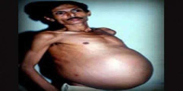 Bhagat: KZ KARDEN KARNINDA TAIYAN ADAM  <br>  Bhagat doum yapyor gibi grnse de aslnda onun ikiz kardei karnndan karlyordu. Bhagat dnyann en tuhaf medikal durumuna sahipti; fetus in fetu (cenin ii cenin). Bu, cenin ikizinin iinde hapis kaldnda ortaya kan bir abnormalitedir.