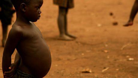 8- Aln sebep olduu rahatszlk ve zayflk, ar besinsizlik yznden karn ve karacierin imesiyle ortaya kan kwashiorkorun yannda hibir eydir. Afrikal zayf ocuklarn kocaman karnlar, kwashiorkor sonucudur. Ancak alk eken insanlarn bir numaral lm sebebi ar doku ve organ hasar sonucunda oluan kalp yetmezliidir.