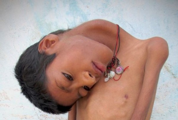 ...Alt aylkken kafas aaya doru aslmaya balad. lk balarda zayf olduunu, biraz beslenirse dzeleceini dndk. Ancak  yana kadar yine ba dorulmad ve biz de korkmaya baladk. O zaman doktora gtrdk. Onlarca doktora gtrdk hibir olumlu yant almadk. Biz de umudumuzu kestik ve olumuza ok iyi bir hayat yaamas iin elimizden geleni yapmaya baladk" dedi.