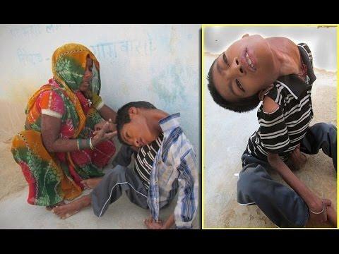 Olunu tedavi edebilmek iin akraba ve arkadalarndan bor para toplayan baba Mukesh, "Doum ncesi bir doktora gitmeye veya ultrason ekmeye gerek grmedik nk btn ocuklarm normal dodu, onlarda herhangi bir hastalk sz konusu deildi. Mahendra da dier kardeleri gibi evde dodu...