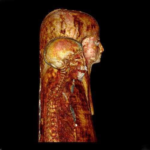 Allm CT taramalarnn aksine, bu kez hastann ya 3.000 civarnda ve tam anlamyla gizemle rtl durumda.