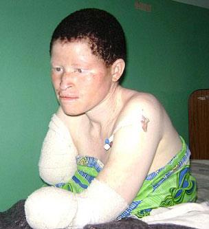 Resmi rakamlara gre Tanzanya'da 2007 ylnda 53 albino, acmaszca katledildi, ans getirdiine inanld iin bedenleri paralanarak satld