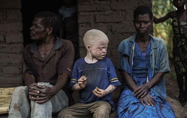 Malavi polisi, albinolar katleden kiilere kar ciddi bir operasyon gerekletirdiklerini dile getiriyor.