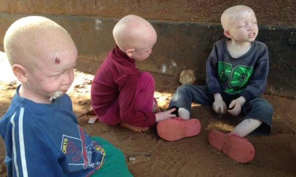 Baz blgelerde Albino bebeklerin doar domaz ldrld belirtiliyor.