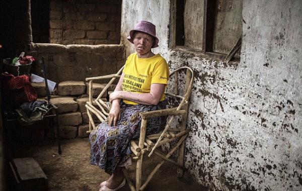 Uzuvlarnn byl gce sahip olduu inanc yznden kurban edilme tehlikesi yaayan albinolar Malavili yetkililerden yardm istedi...