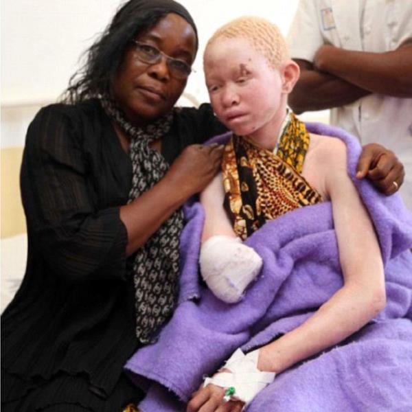 Bir albinonun organlar 75 bin dolara kadar alc bulabiliyor.