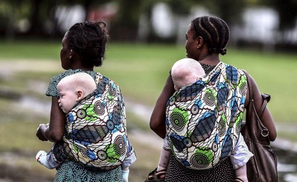 Afrika&#8217;daki albinolar, cinayetlere maruz kalmalarnn dnda saldrlarla ve ayrmclkla karlayor. Albinolar darda gn nda almak zorunda kaldklar ilerde ise deri kanserine yakalanma riskiyle kar karya bulunuyor.