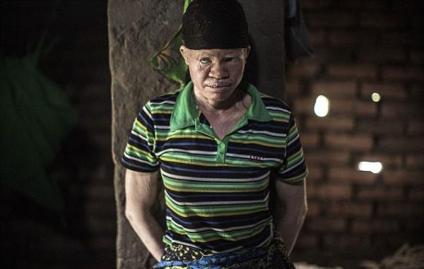 Ten renkleri yznden acmaszca ldrlen albinolar korku iinde yaamlarn srdrmeye alyor...