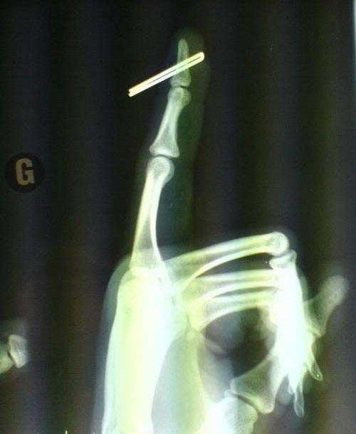 X Ray cihaz: Almanya'da kefedildi  19. yy'da Alman bilim adam Wilhelm Rntgen radyasyon ile deney yaparken kemiklerin grndn kefetti.