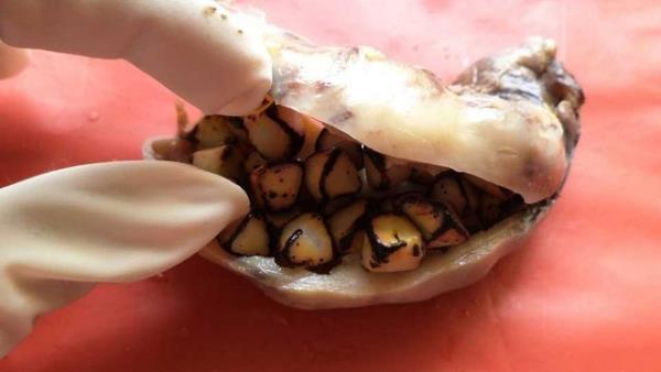 Safrakesesi Ta: Kadnlarn yzde 20'sinde, erkeklerin yzde 8'inde safrakesesi ta oluur.