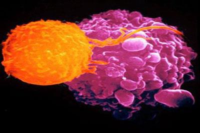 Kaln barsak kanseri: Kaln barsaklardaki polipler zamanla kansere dnebilir ve bunlar hi belirti vermezler. Bu nedenle 50 ya zerindeki herkese periyodik olarak kolonoskopi yaplmal. Bu tetkikte bir tp ile ansten girilerek tm kaln barsak gzlenmektedir. Polip bulunursa bunlar endoskopi srasnda karlr ve tedavi tamamlanm olur. Birok kii kolonoskopiden ekinmekte. Oysa ki gnmzde bu tetkikin yaplmas ok kolaylam. Tetkik srasnda hasta uyutulduu iin herhangi bir ac ya da ar duymamakta. Kansere dnebilen polip bulunmusa kolonoskopinin bir yl sonra tekrar gerekir. Normal bulunan kiilerde 3 ile 10 yl arasnda tetkiki tekrarlamak gerekir. Ayrca ylda bir kez dkda gizli kan baklmaldr. Dkda kan bulunan kiilerde kaln barsak kanseri olabileceinden kolonoskopiyle barsaklar incelenmeli.