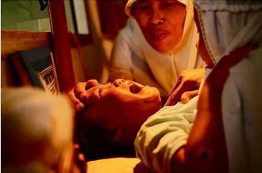 Yetikinlie adm atan kadnlarn cinsel birleme yaamasn nlemek iin, klitoris dudaklar birbirine dikiliyor. Bu uygulama Afrika, Orta Dou, ve Asya'nn baz blgelerinde gerekletiriliyor ve olduka tehlikeli bir ayin olduu biliniyor.