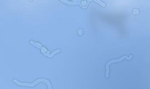 Zaman zaman gzmzn nnde oluan ufak ekiller (takip de edilebilen), gzn vitrz svsndaki proteinlerin yansmasdr.