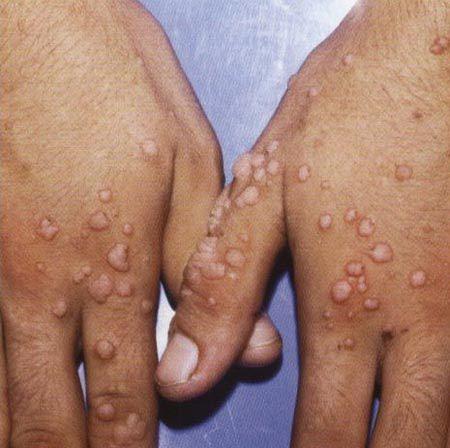 Siillerinizin stne gnde 3 defa 15 dakika sreyle lk poet ay bastrn.getiini greceksiniz. ay yapraklarndaki tanik asit mucizesi.