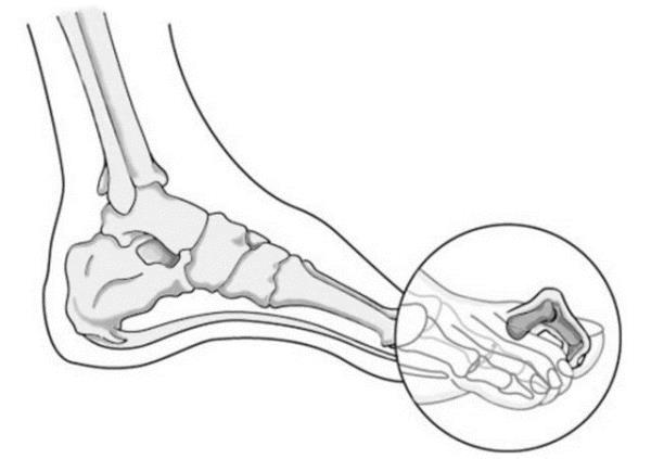 En ok ve kolaylkla tlayan yerler vcudumuzda en ok bulunan srtnmeli eklem yerleridir.