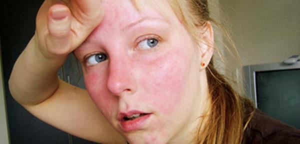 Yz kzarmasndan korkma (eritrofobi)