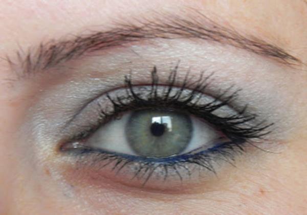 Dr. Rosenthal, gzn tamamen iyilemesinin 1 ya da 2 ay sreceini her hangi bir enfeksiyon durumunda ise silikonu kolayca karmann mmkn olacan belirtti.