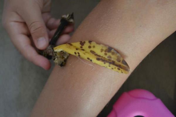 Sinek srklklarnn neden olduu kantya muz iyi gelir.