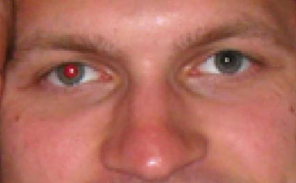 Eer bir fotorafnzda sadece bir gznz krmz ktysa, bu retinoblastom (bir eit gz kanseri) belirtisi olabilir.