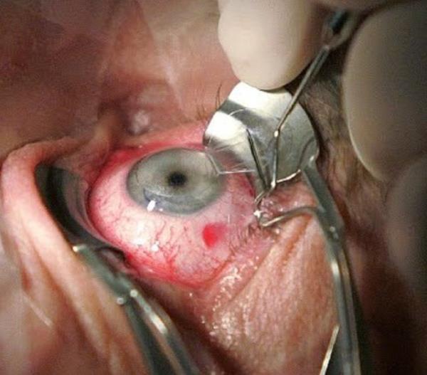 6. ldm de haberim mi yok? dedi.<br>  12 yandayken yz kemiklerinden ameliyat olan Shelley ameliyat srasnda uyanr ve btn yz kemiklerinin teker teker krlmas ve pensle yerinden karlmasna anbean tank olur.