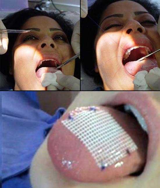 Bu dikiler sayesinde kii, kat gda yedii zaman can o kadar ok acyor ki sadece sv ile beslenmek zorunda kalyor.