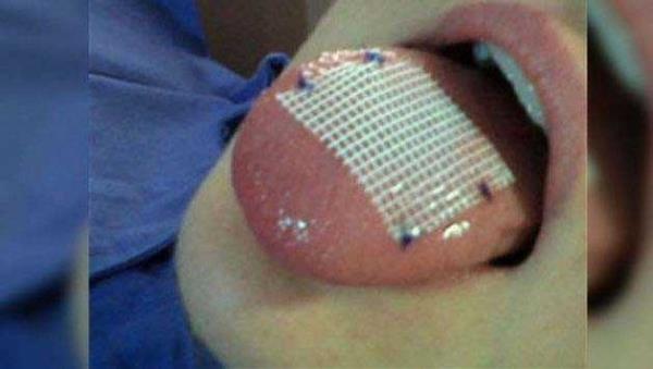 Dil yamas lkemize ok kr gelmemi bir yntem olan dil yamalar, dilin zerine atlan 6 adet dikiten oluuyor.