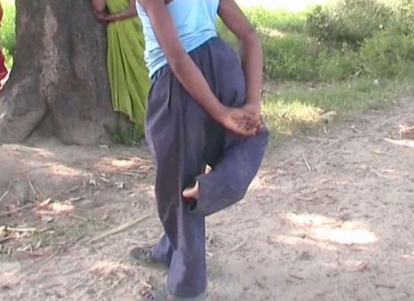 Hindistan'n Uttar Pradesh eyaletinin Farukabad ehrine bal bir kyde yaayan 20 yandaki Arun Rajput drt bacakl olarak dnyaya geldi. Doktorlarn tahminine gre; Rajput'un arkasndaki bacaklar anne karnnda gelimemi olan parazit ikizinin yadigar...