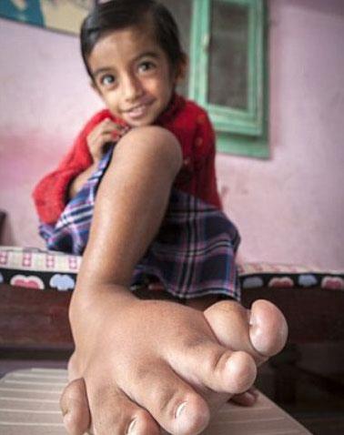 Bat Hindistan'n Gujarat kentinde yaayan Joshi'nin hayat sa ayandaki 5,4 kilogramlk arlkla zorluklar iinde geti. Gittii baz doktorlarn herhangi bir hayati  risk tamadn sylese de birok doktor ayann kesilmesi gerektiini syledi...