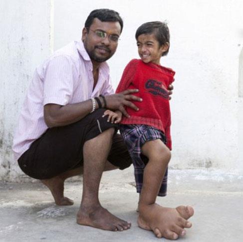 Hindistan'da ve yurtdna gtrlp birok doktora tatarfndan muayene edildi. Genel kan ise beslenmeden kaynakl hormonal bozukluk olabilecei belirtildi. Baba Dilip Joshi, evladnn aya kesilmesin diye almad kap kalmad. Gittii her doktorun ayan kesilmesi gerektiini sylemesine ramen buna kar ktn syledi...