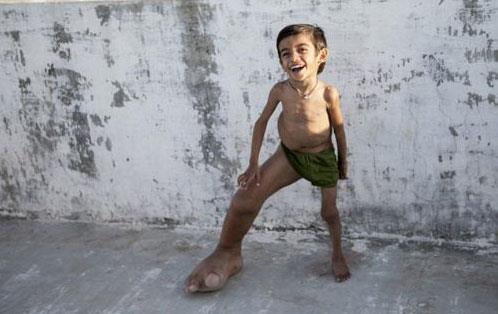 4 yandaki ocuun devasa ayan grenler hayretler iinde kald. Doduunda sa aya sol ayana gre anormal derecede byk olan 4 yandaki Verdant Joshi'yi  grenlerin yrei burkuldu...